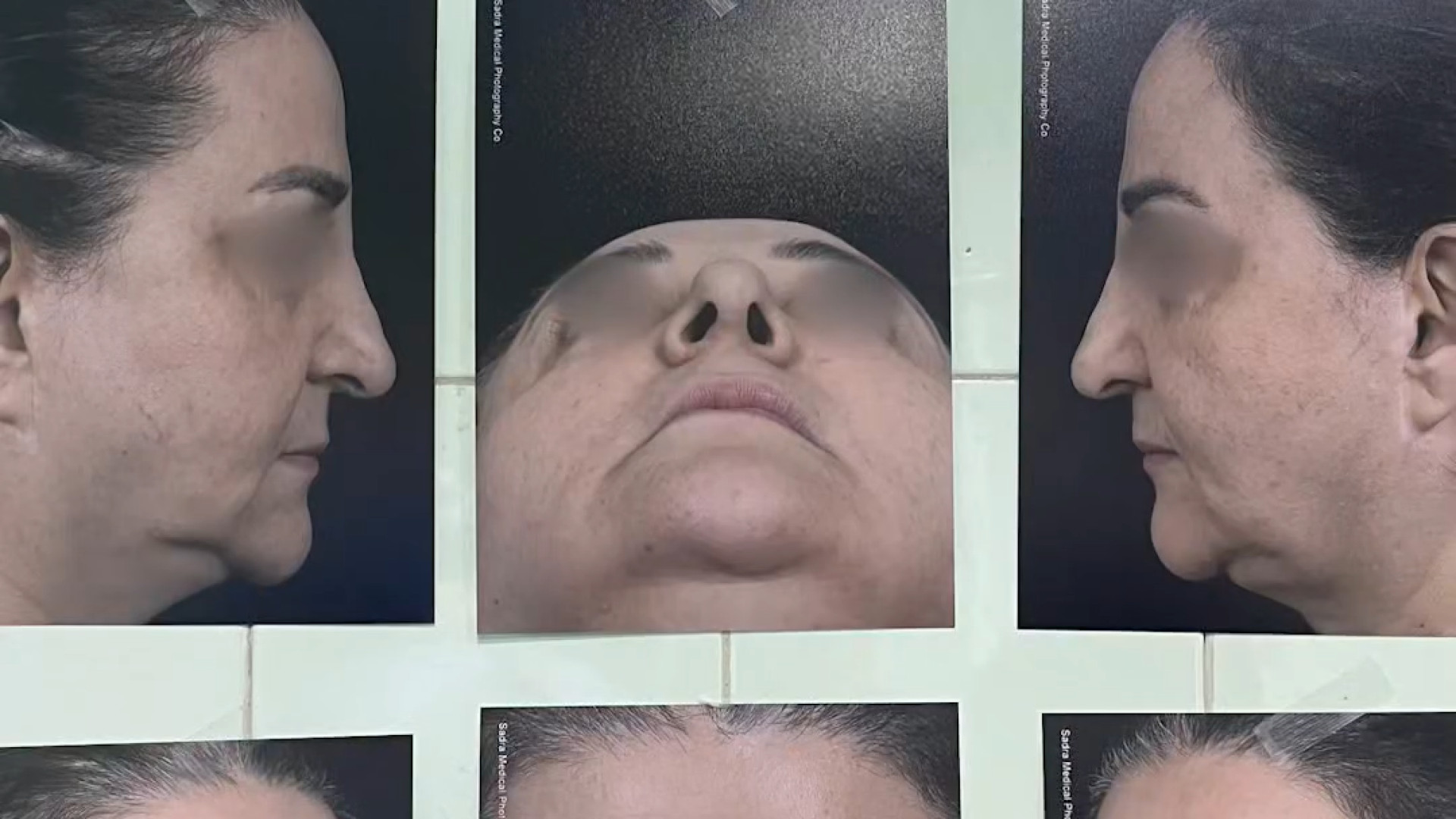 جراحی ترمیمی بینی با تکنیک پیوند غضروف دکتر علیرضا بابایی،فوق تخصص جراحی پلاستیک و زیبایی