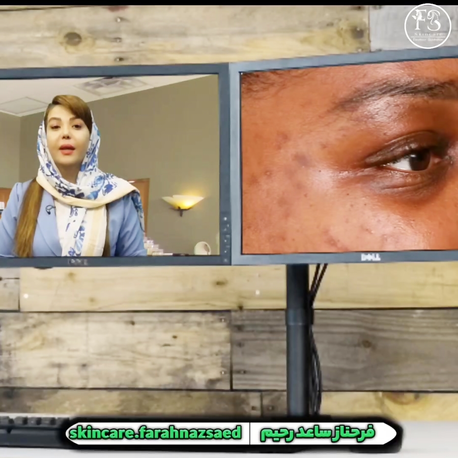 اسید تراپی پوست صورت