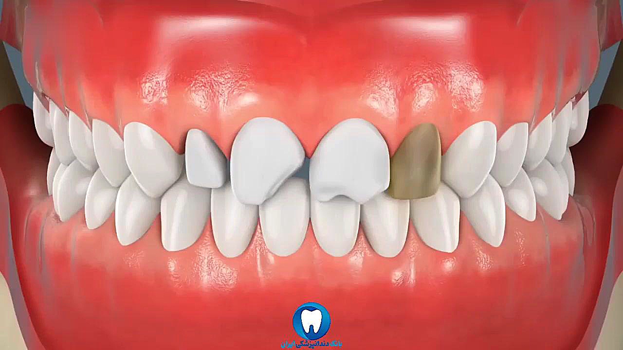 لمینت دندان ایمونولوژی محاسباتی