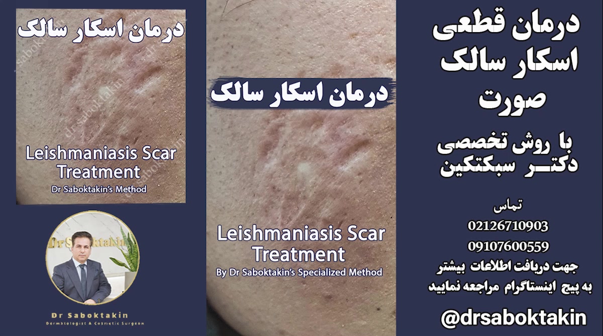 درمان اسکار سالک -بهبود بالای 80 درصد دائمی به روش تخصصی دکتر سبکتکین- لیزرسالک لیزر صورت