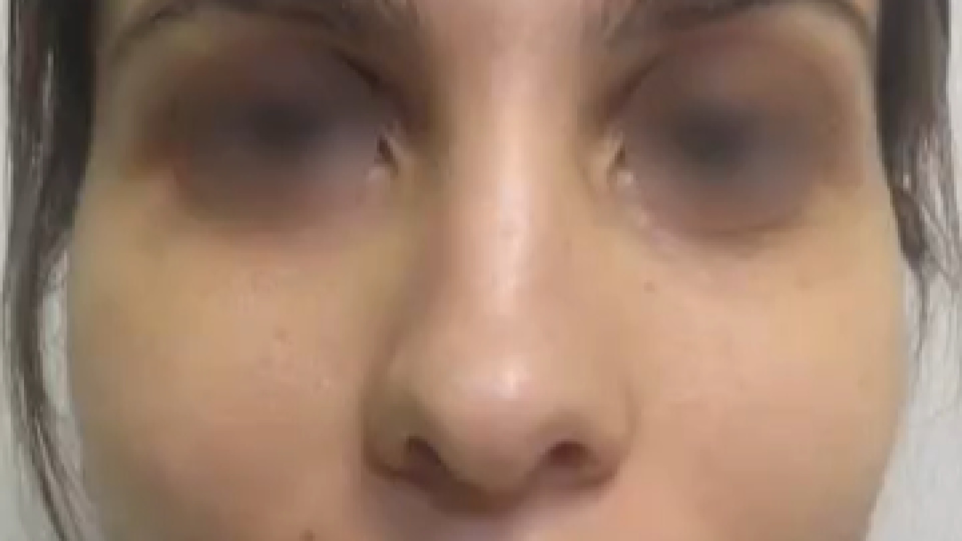 نتیجه رینوپلاستی دکتر محمودرضا اصحاب یمین - فوق تخصص پلاستیک