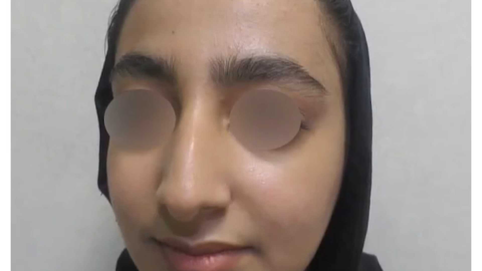 نتیجه رینوپلاستی دکتر محمودرضا اصحاب یمین - فوق تخصص پلاستیک