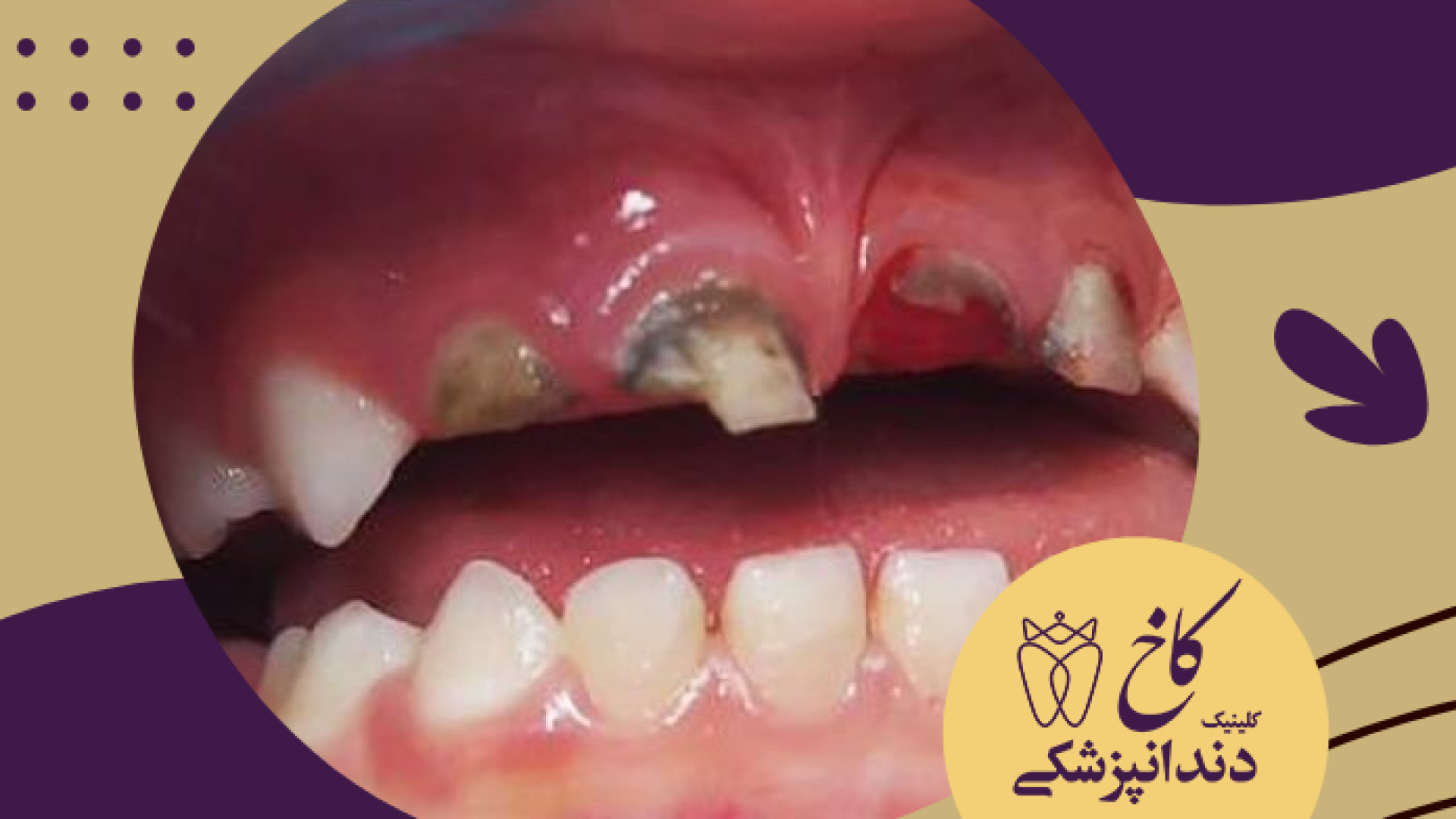 ترمیم دندان شیری کودک دو ساله کلینیک مو