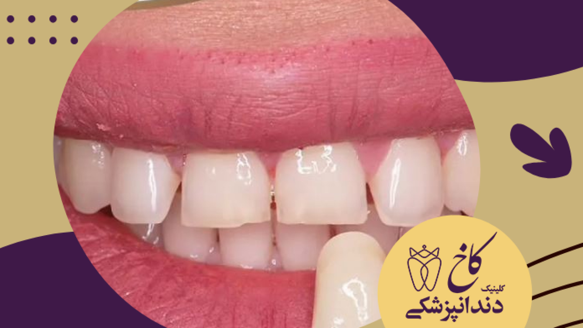 طراحی لبخند با لامینیت کلینیک دندانپزشکی کاخ