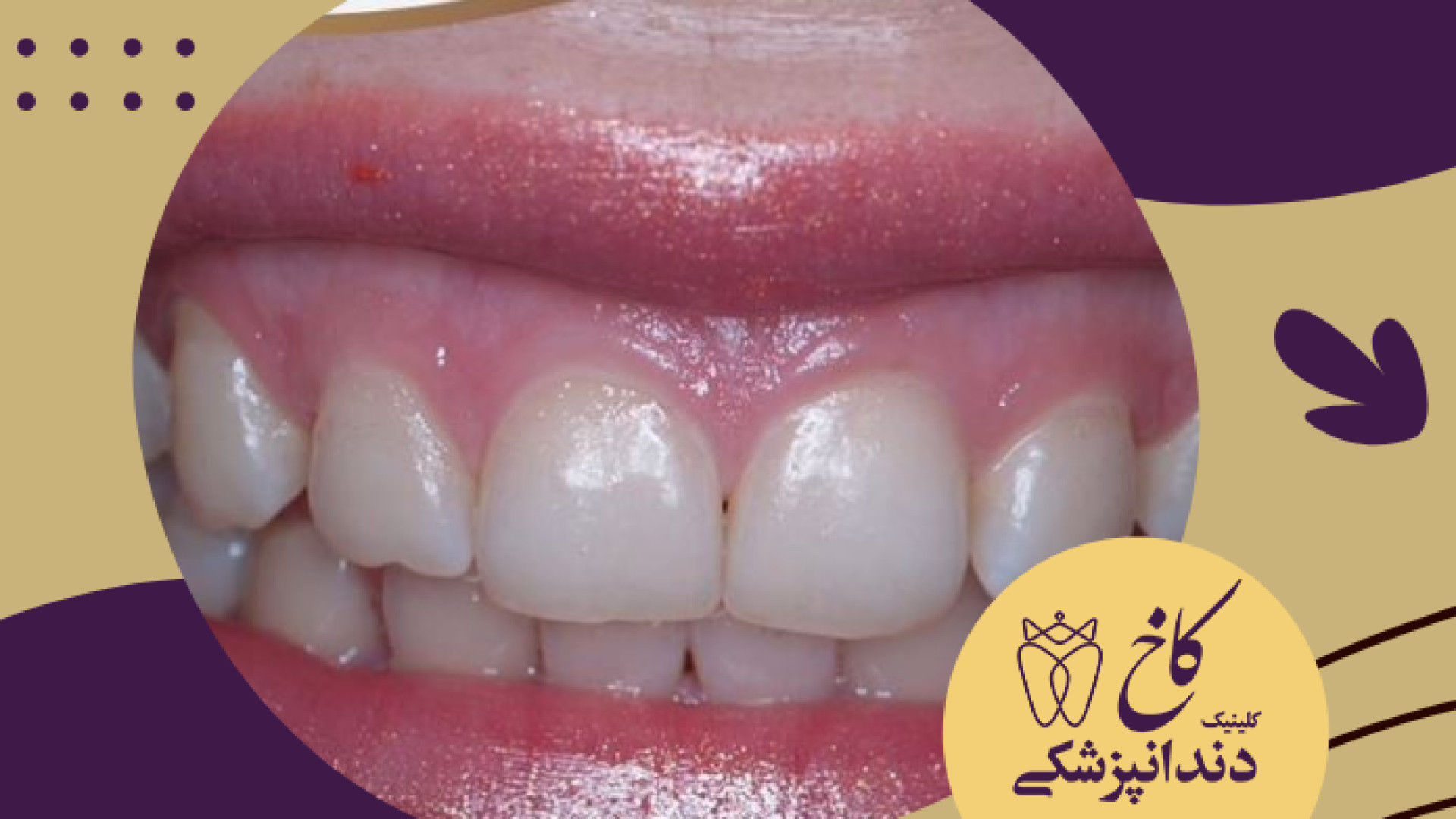 یک طراحی لبخند دیگر با لامینیت کلینیک دندانپزشکی کاخ
