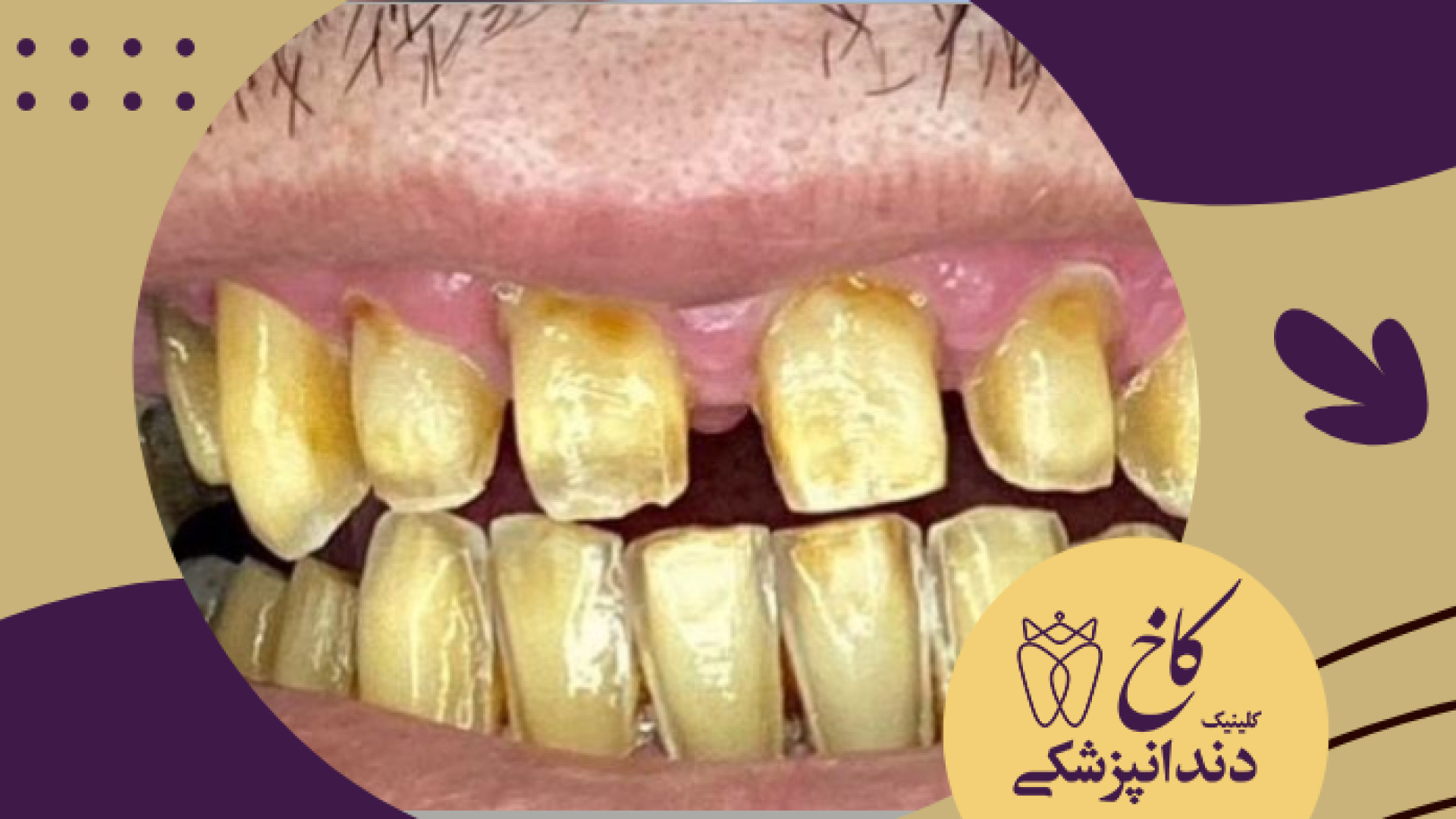 طراحی لبخند زیبا کلینیک دندانپزشکی کاخ