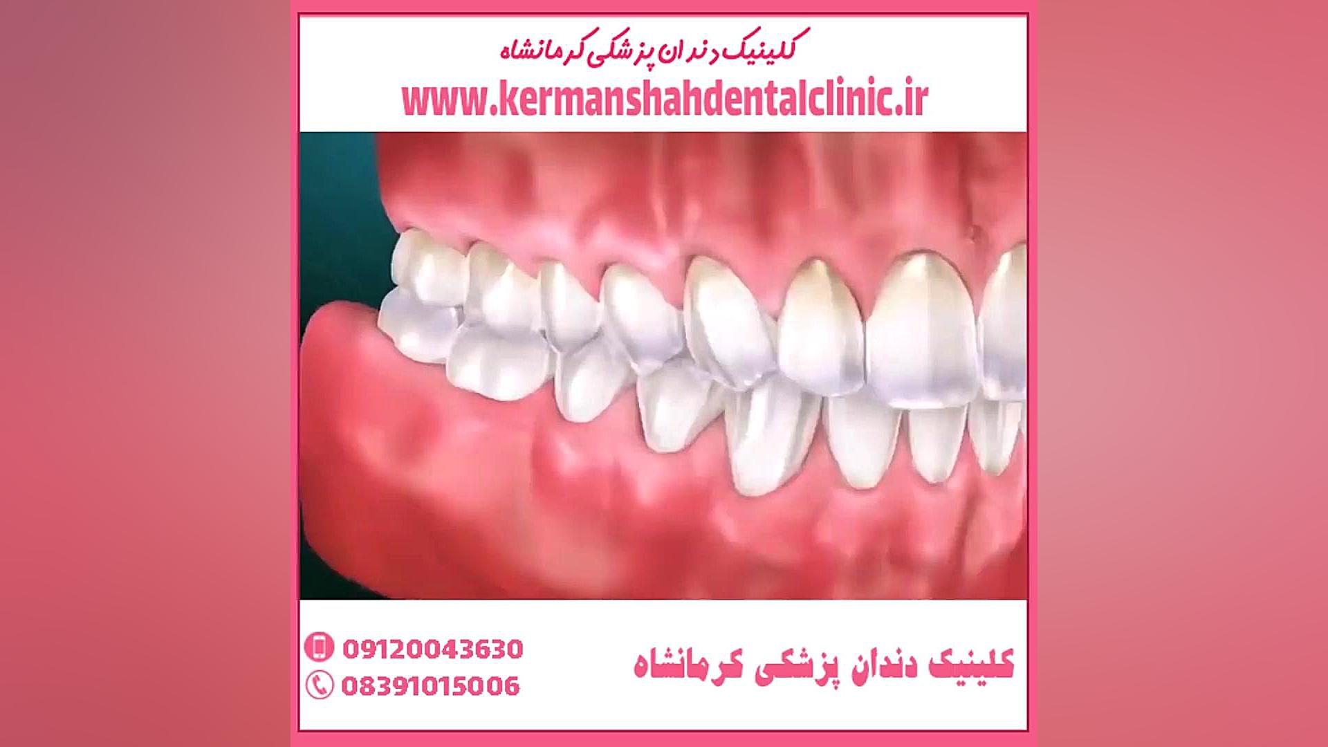 ترمیم دندان بیماری کاوازاکی