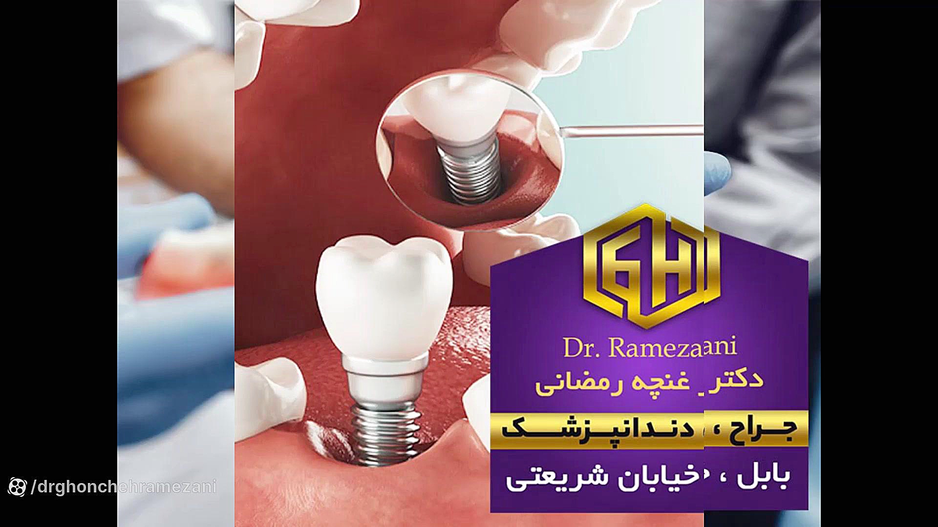 هزینه کامپوزیت ونیر دندان بابل و بابلسر | دکتر غنچه رمضانی ترومبوسیتوپنی مقاوم