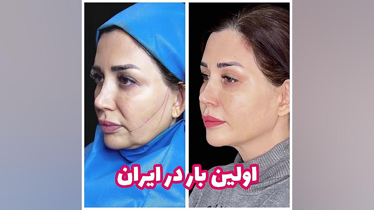 نخ دائمى فرانسه دندان پیش