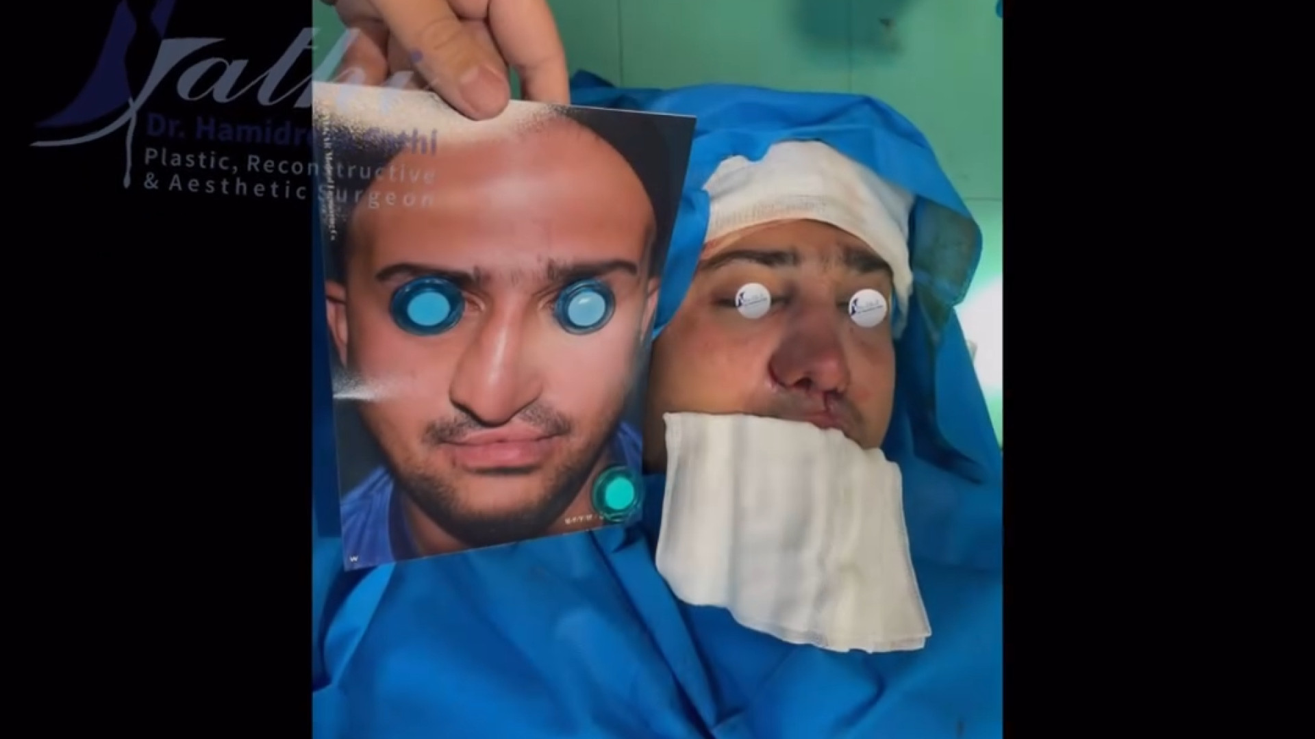 فیلم اتاق عمل جراحی رینوپلاستی و شکاف کام و شکاف لب دکتر حمید رضا فتحی فوق تخصص جراحی پلاستیک