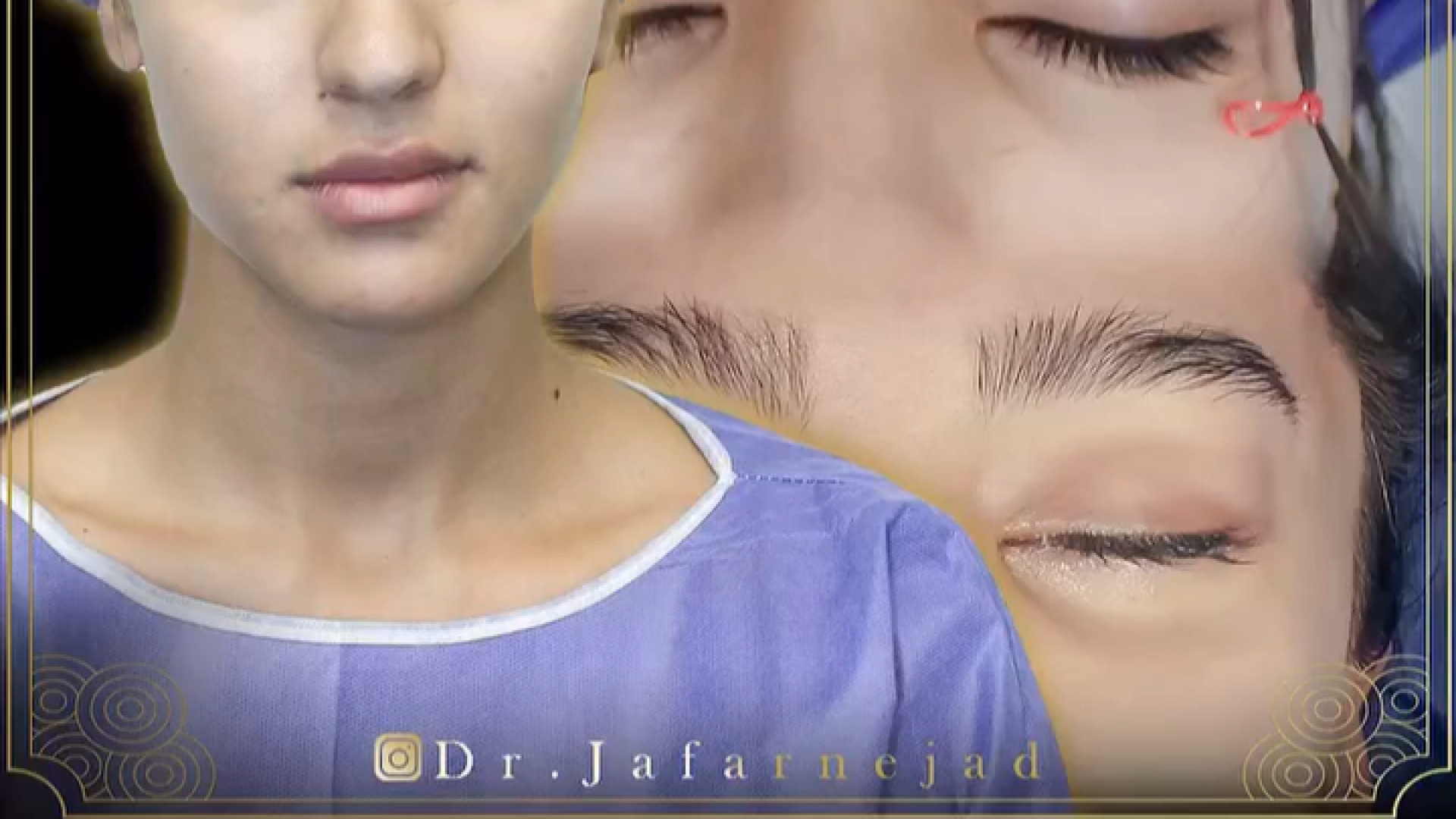 عمل لیفت شقیقه بصورت نچرال زیباجوی عزیزمون دکتر بابک جعفرنژاد