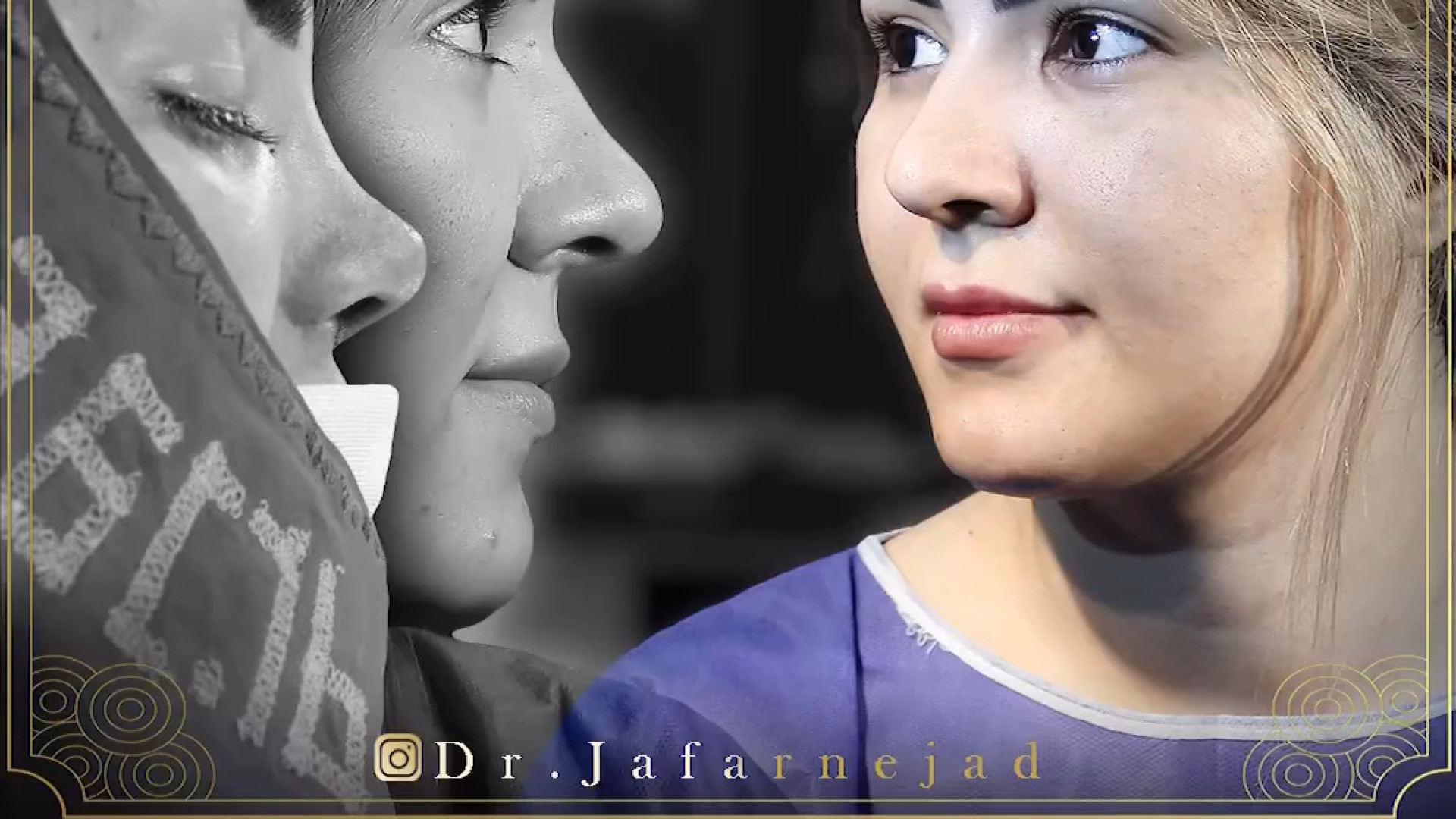 بلافاصله بعد از عمل بینی نیمه فانتزی دکتر بابک جعفرنژاد