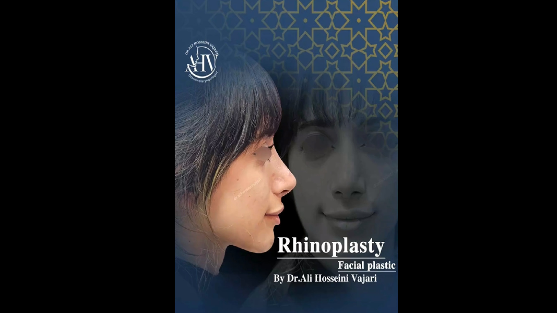 جراحی بینی توسط دکتر واجاری دکتر علی حسینی واجاری - جراح بینی رشت