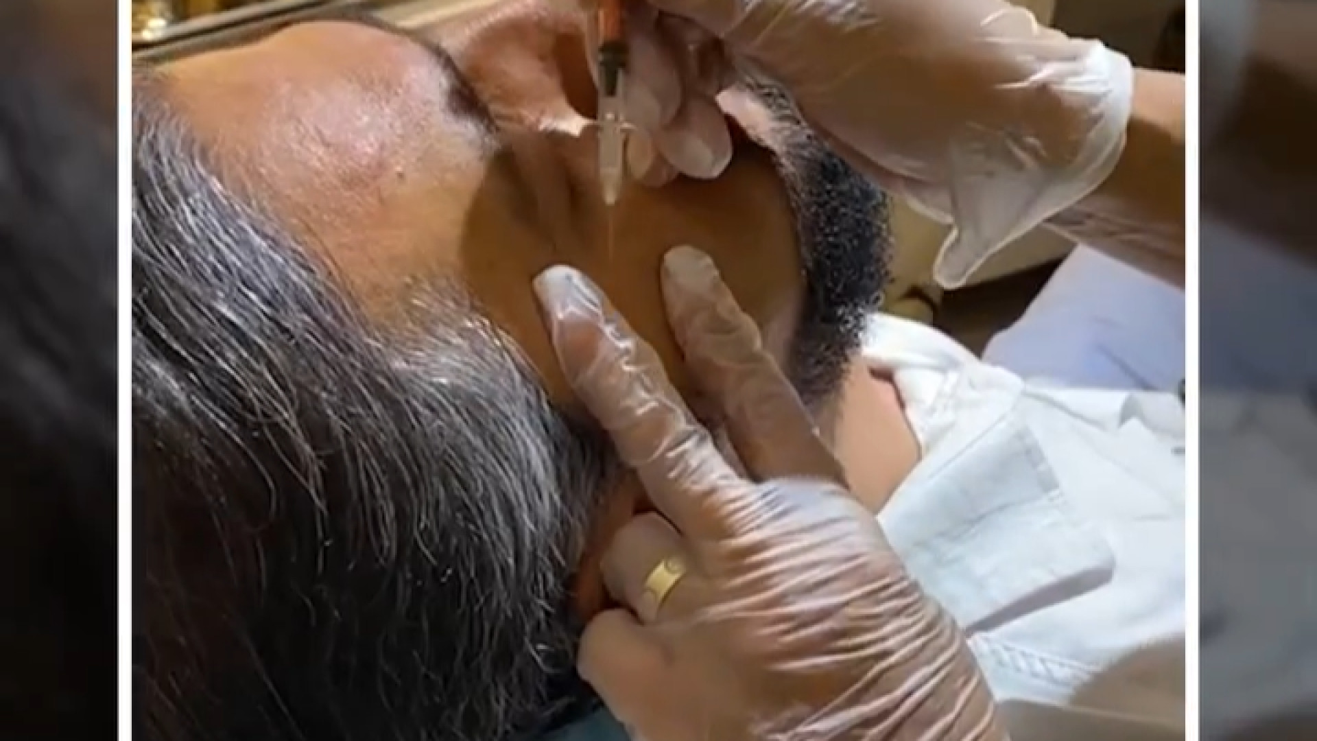 فیلم واقعی تزریق بوتاکس آقایان لیزر کوانتومی جراحی چشم