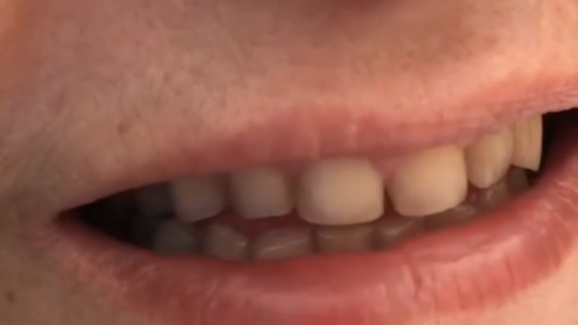 لبخند و رضايت زیباجوی عزیزمون دکتر ندا هادی-دندانپزشک زیبایی