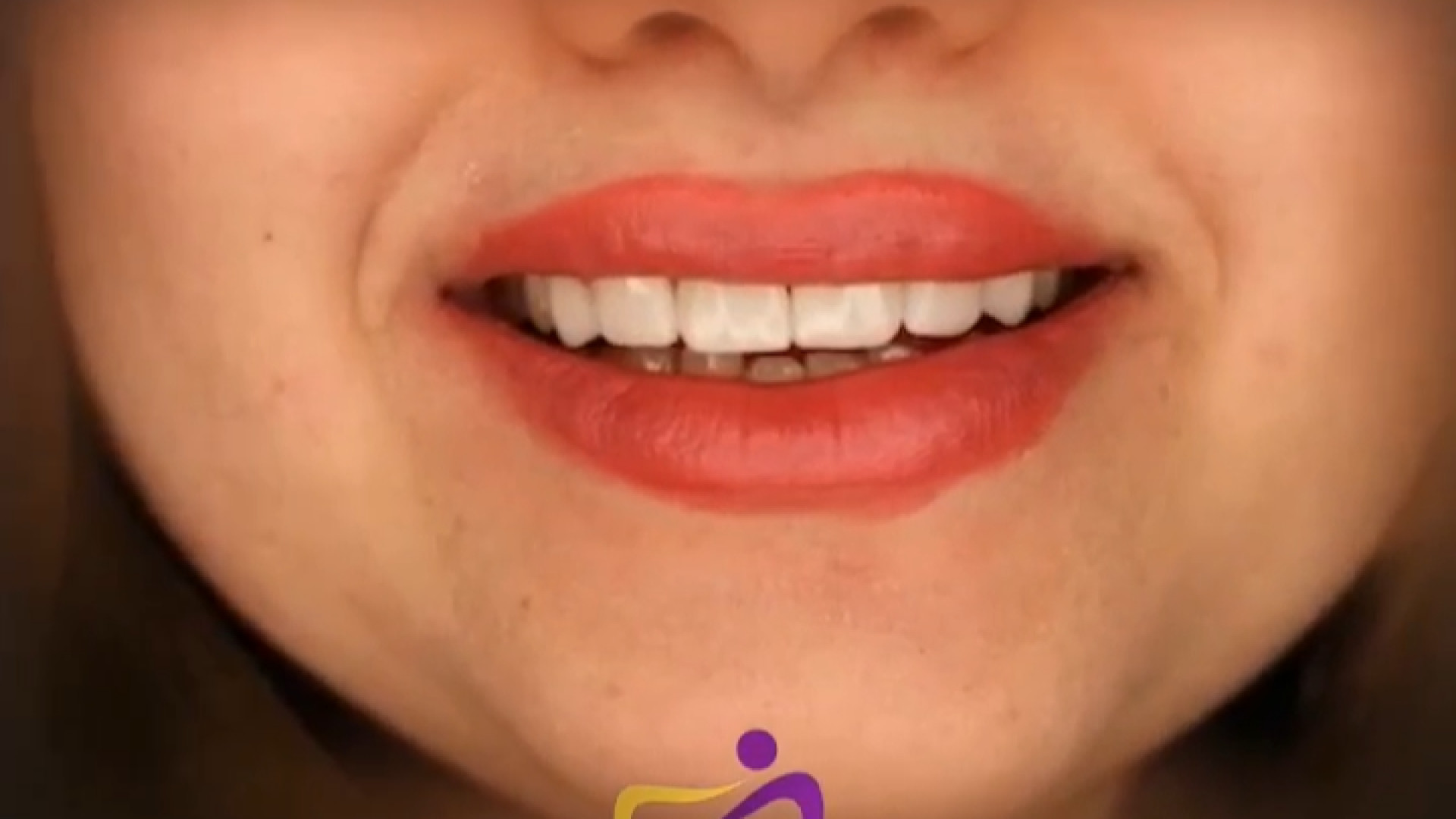 نمونه کار لمینت دندان دکتر ندا هادی-دندانپزشک زیبایی