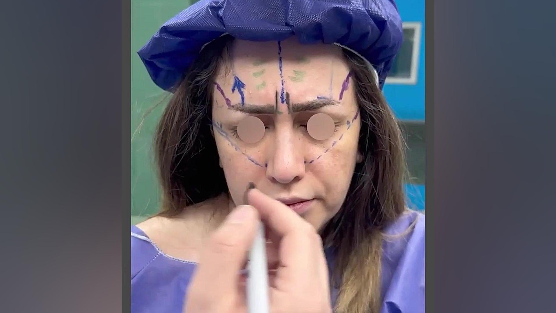 لیفت آندوسکوپی پیشانی | دکتر عطا حیدری Anti-CCP