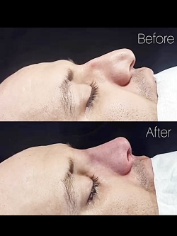 قبل و بعد عمل بینی مردانه - دکتر لیلا شریفی