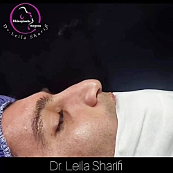 نمونه عمل بینی مردانه - دکتر لیلا شریفی