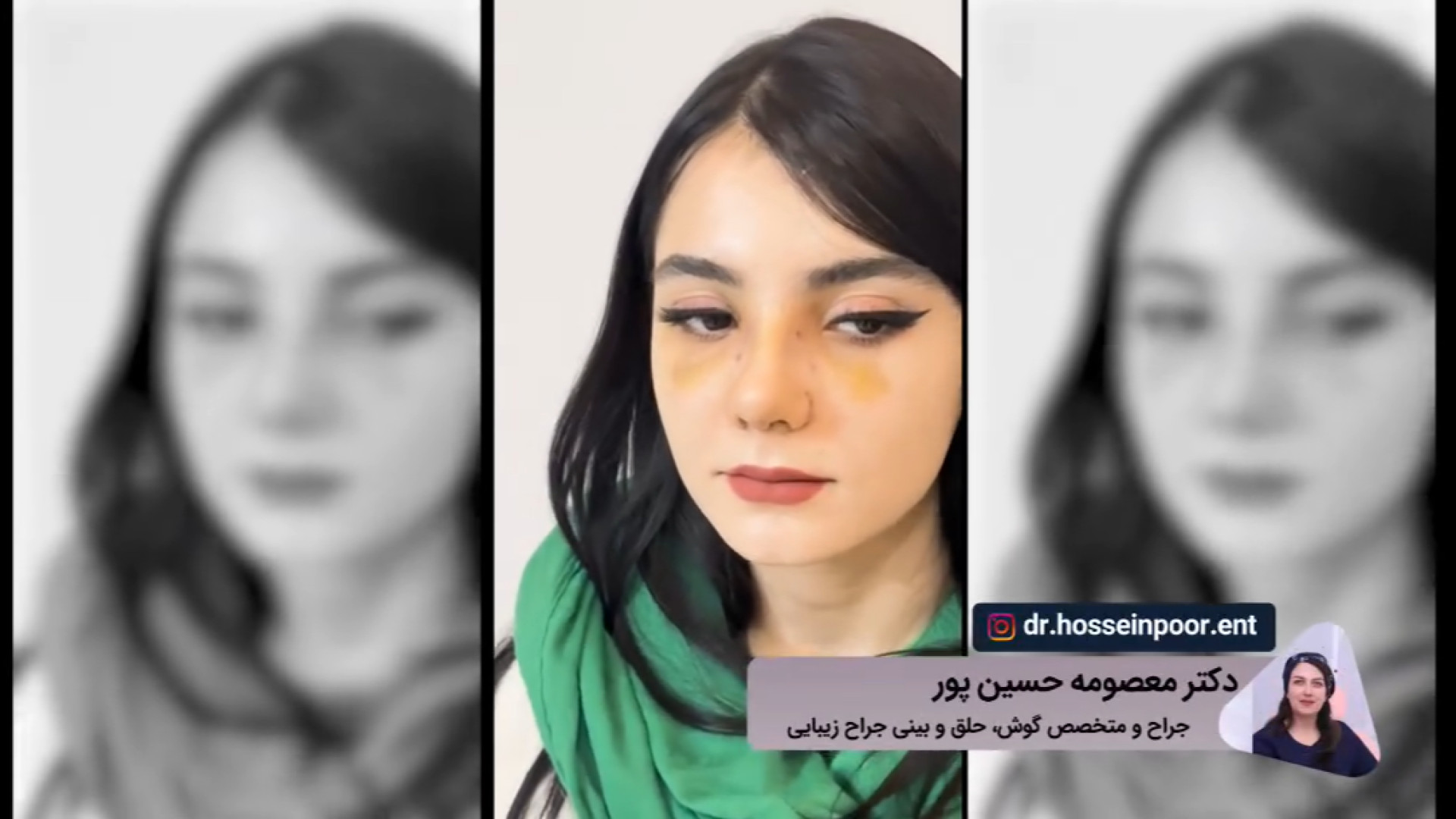 فیلم قبل و بعد عمل بینی دکتر معصومه حسین پور