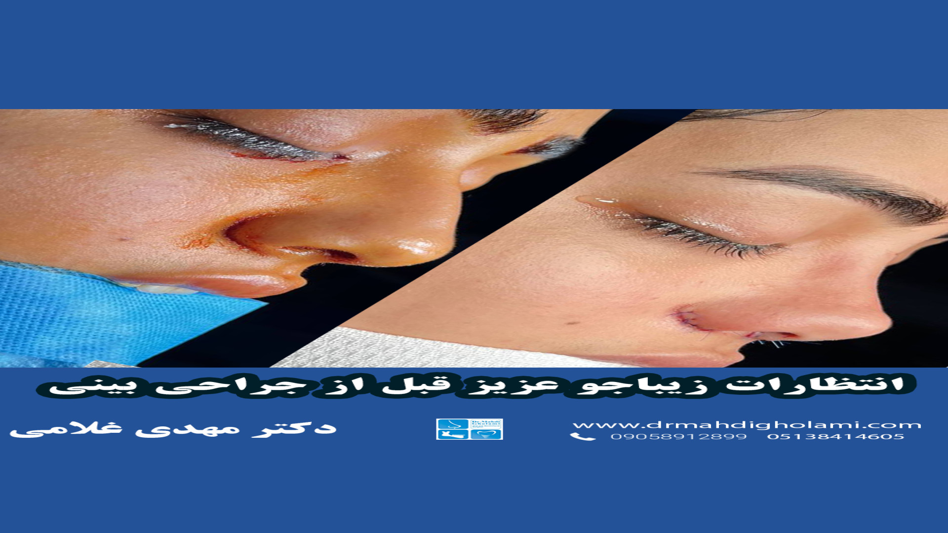 عمل زیبایی بینی با دکتر مهدی غلامی دکتر مهدی غلامی