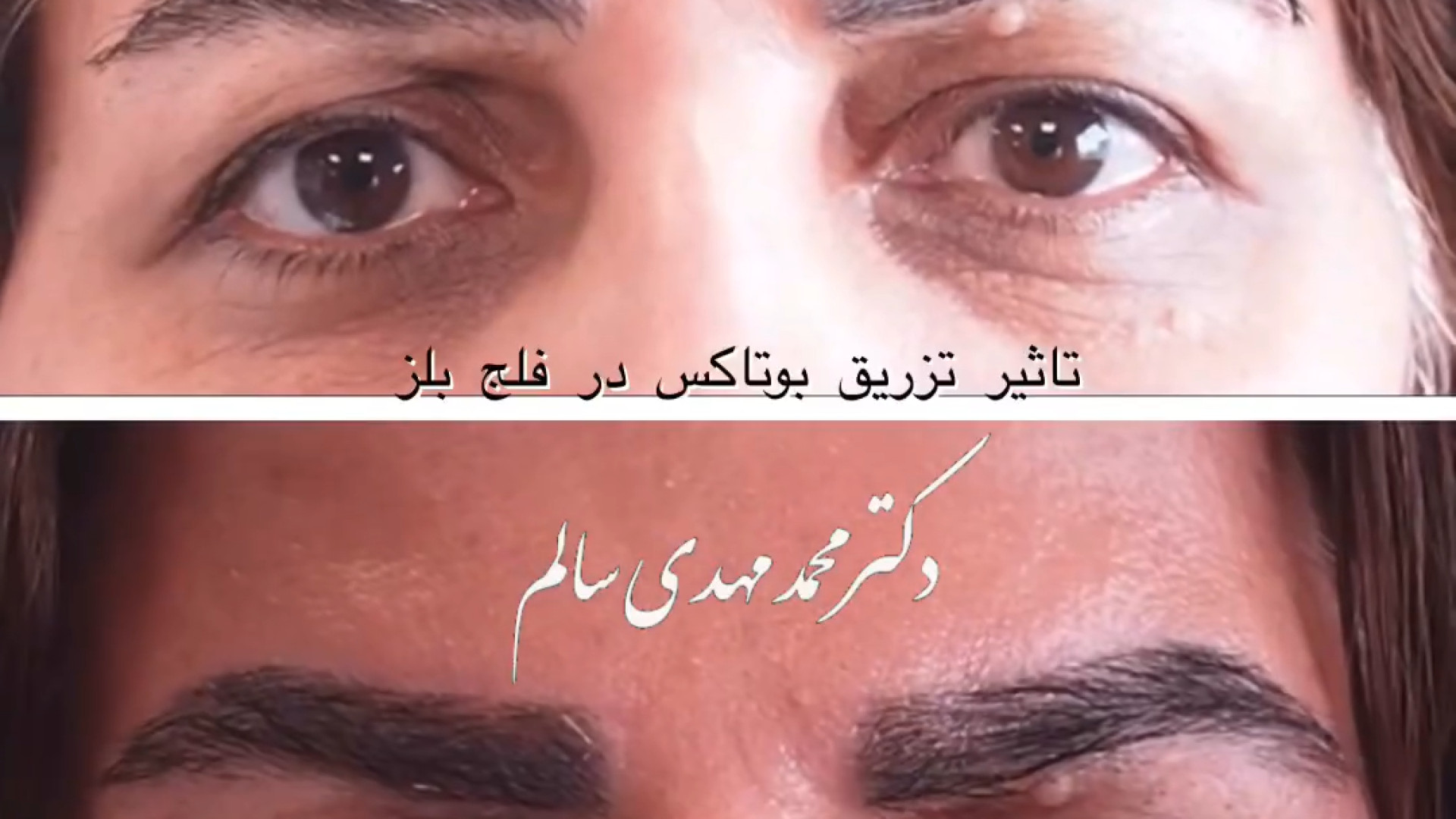تاثیر تزریق بوتاکس در فلج بلز عصب‌کشی