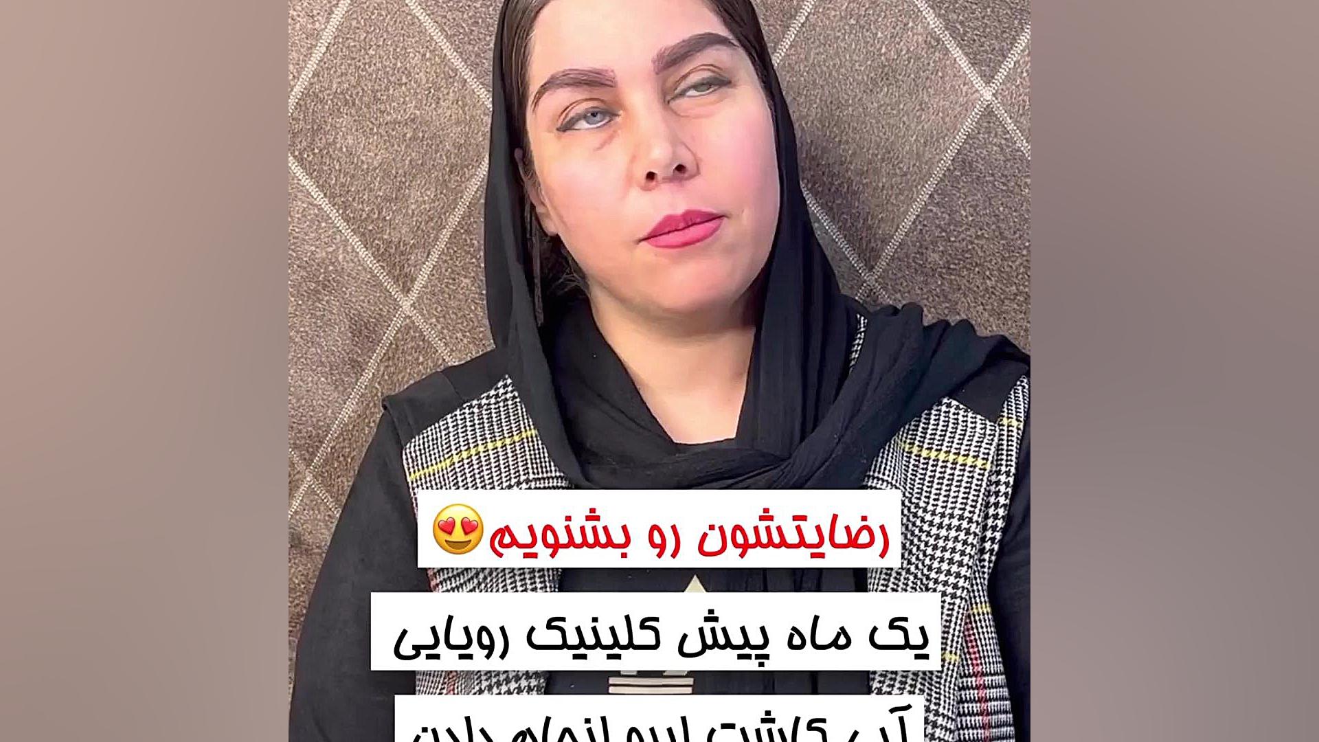رضایت بعد از یک ماه از کاشت ابرو در شاهین شهر اصلاح فرم صورت