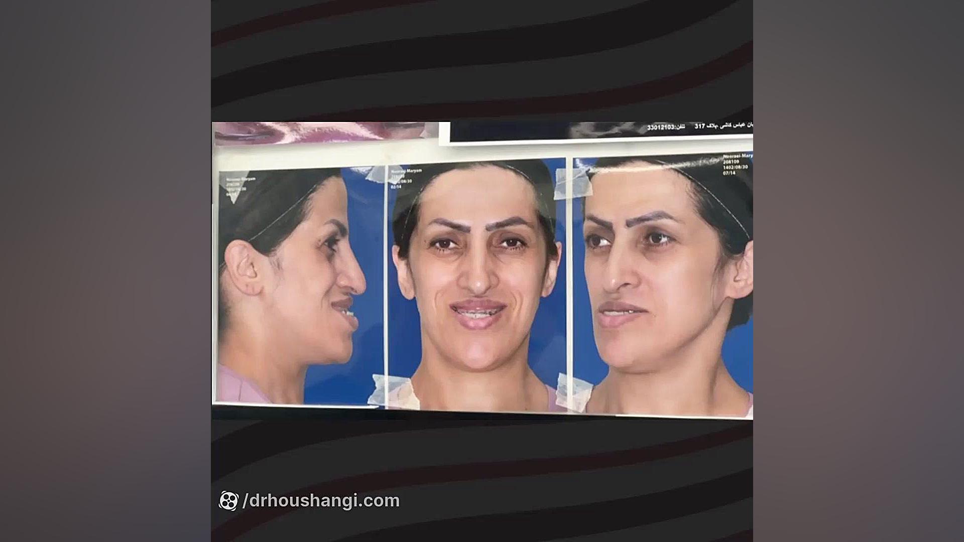 نمونه جراحی فک و صورت ایمونوانژیوگرافی