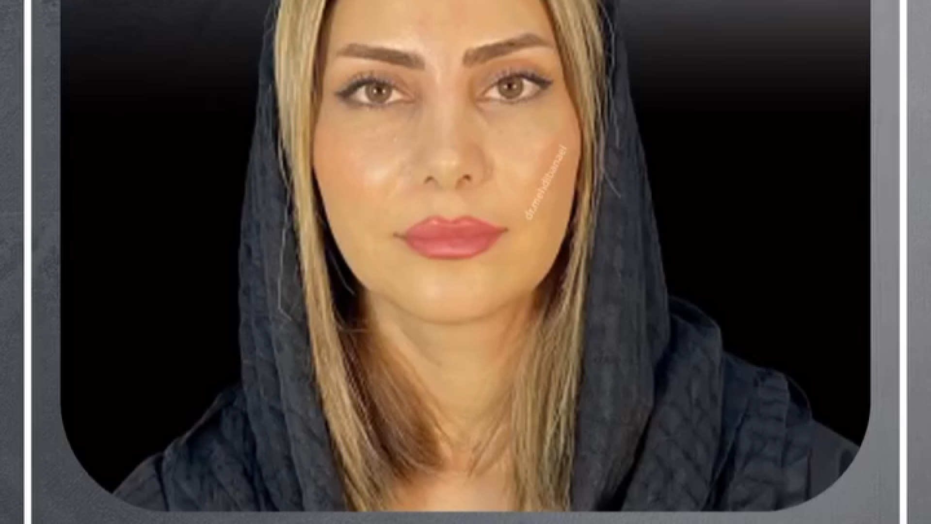نتیجه فوق العاده جراحی بینی