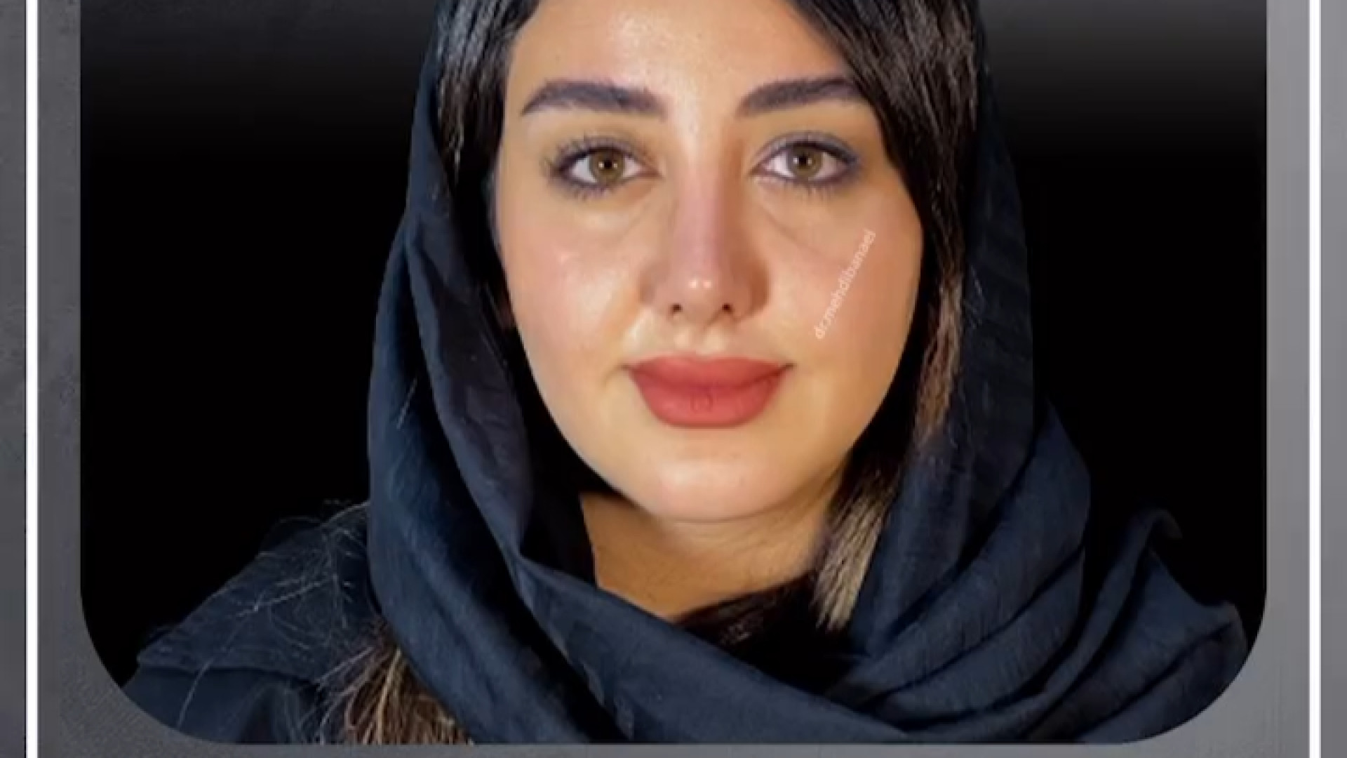 جراحی بینی طبیعی