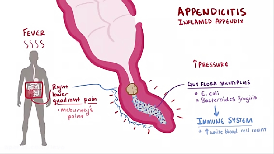 Appendicitis Signs Symptoms 3040