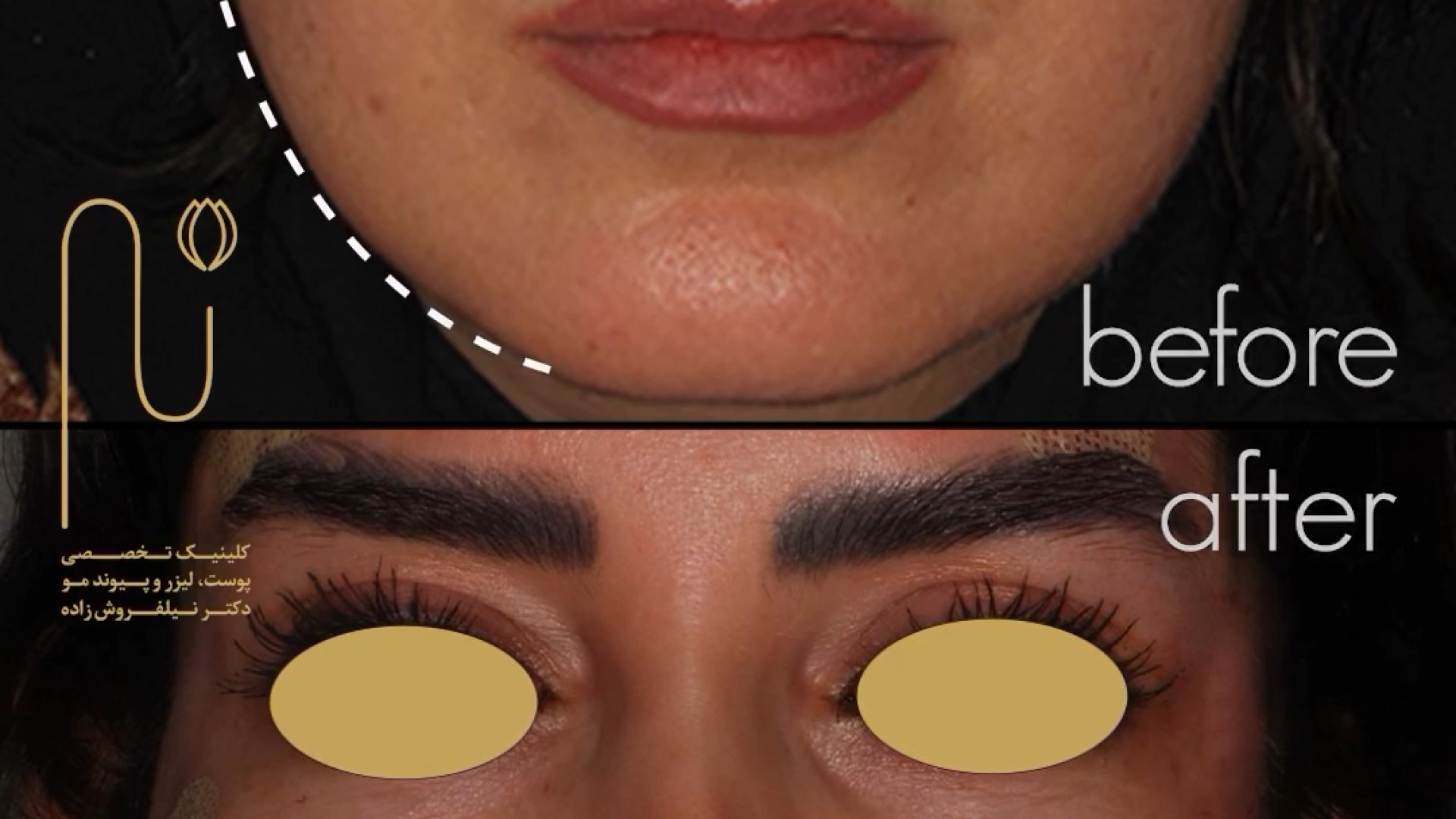 فیلم لیفت صورت با نخ درمان سلولیت