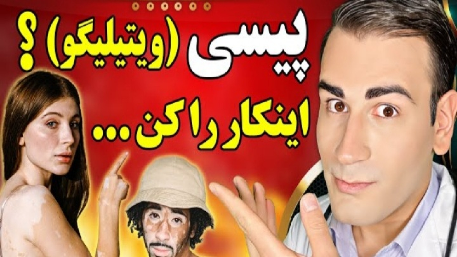 برای درمان پیسی (ویتیلیگو) یا برص اینکار ها را انجام بده! مهران مدیری