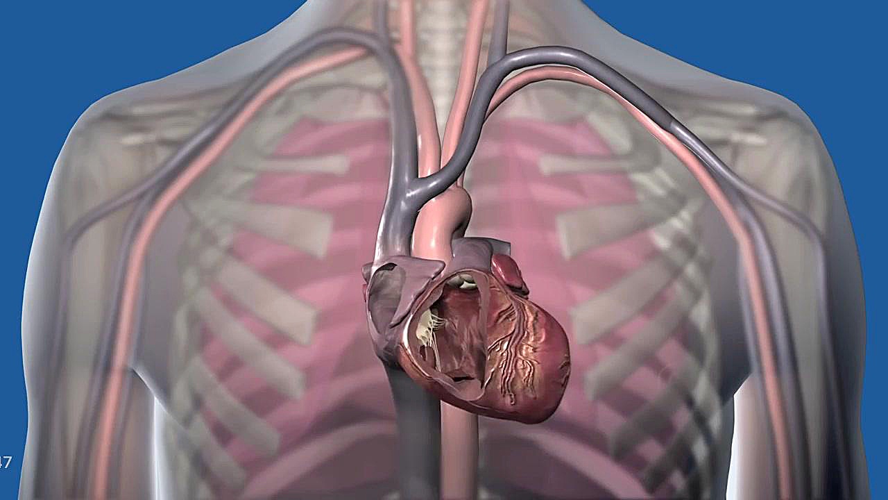 دستگاه شوک کاشتنیImplentable Defibrillator برداشتن توده