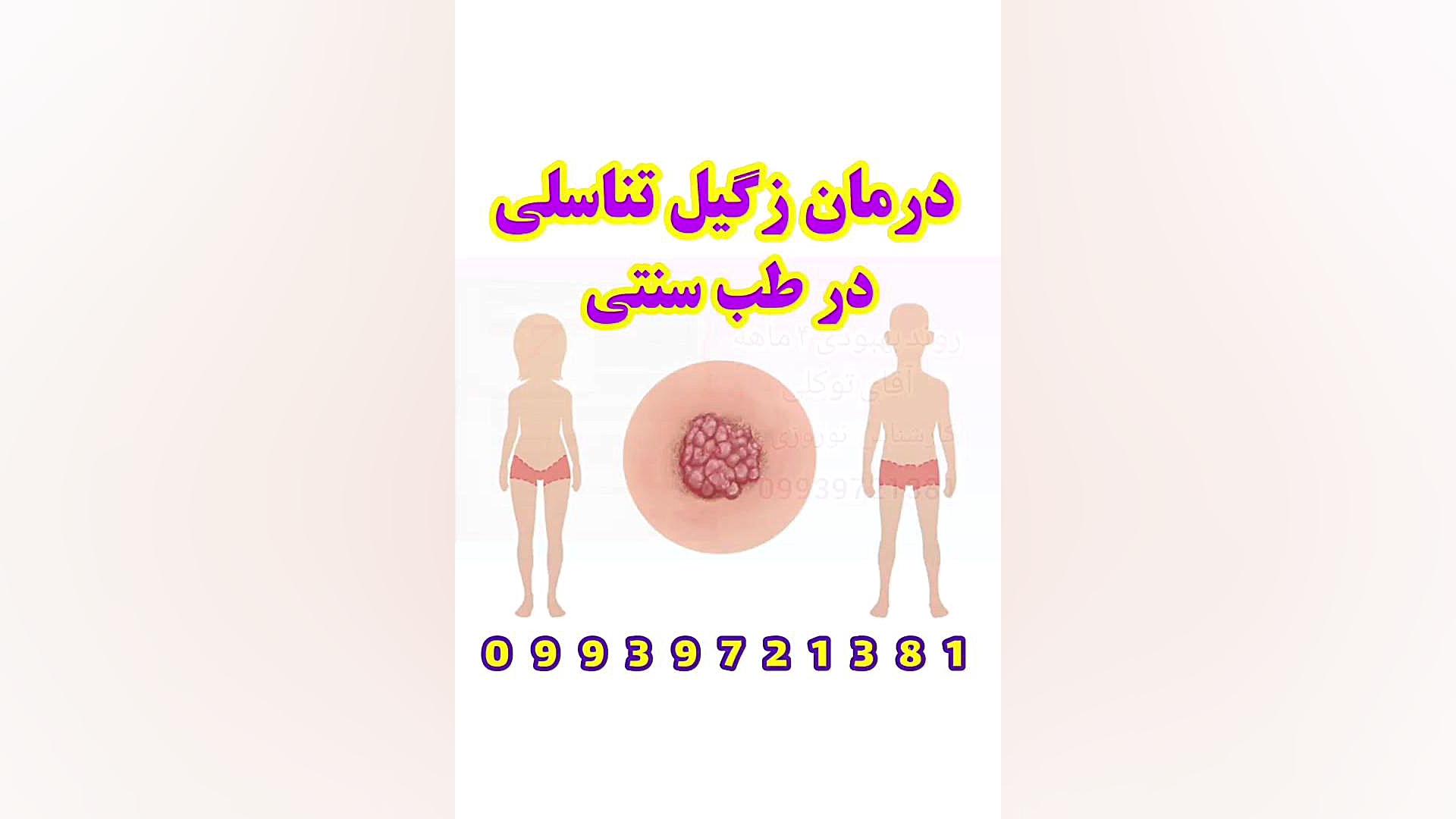 زگیل تناسلی در مردان لیلا حاتمی