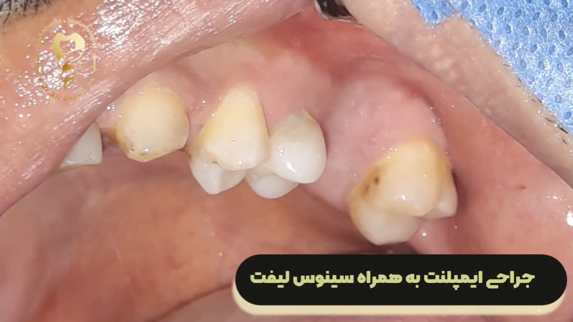 فیم جراحی ایمپلنت دندان به همراه سینوس لیفت دکتر علی قمری - متخصص جراحی لثه و ایمپلنت