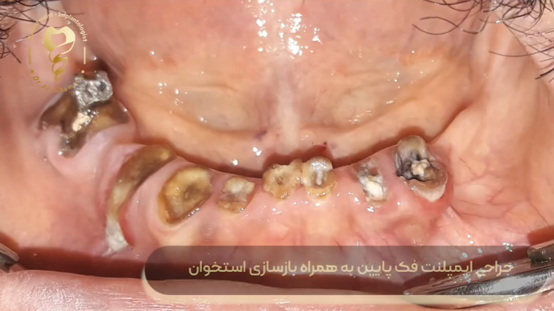 فیلم جراحی ایمپلنت دندان فک پایین به همراه جراحی بازسازی استخوان دکتر علی قمری - متخصص جراحی لثه و ایمپلنت