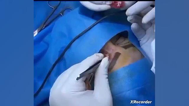 بلفاروپلاستی در مطب دکتر ویسی متخصص جراحی عمومی در کرمانشاه ترمیم لبخند لثه‌ای