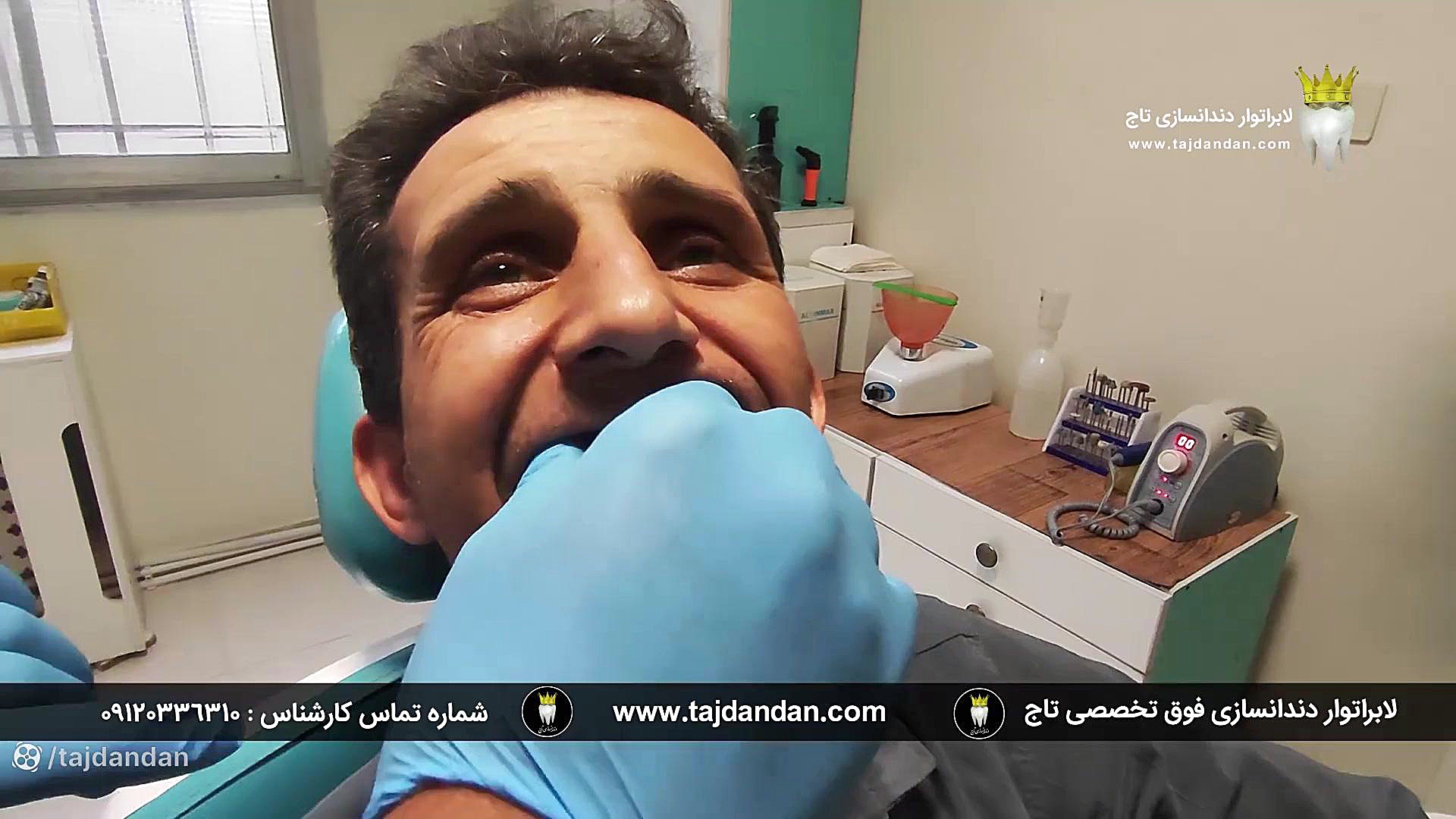 مراجعه و رضایت بیمار 5 سال بعد از ساخت پروتز دندان ایووبیس سوئیسی توسط تاج دندان رفع افتادگی پلک