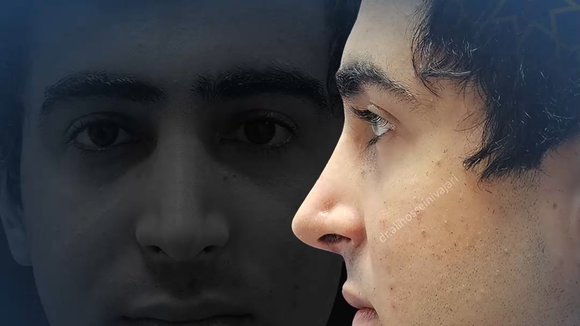 جراحی زیبایی بینی دکتر علی حسینی واجاری - جراح بینی رشت