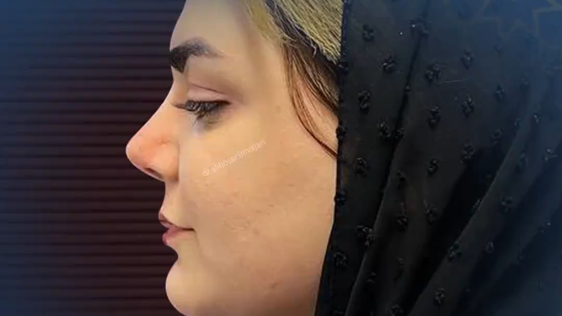 عمل رینوپلاستی دکتر علی حسینی واجاری - جراح بینی رشت