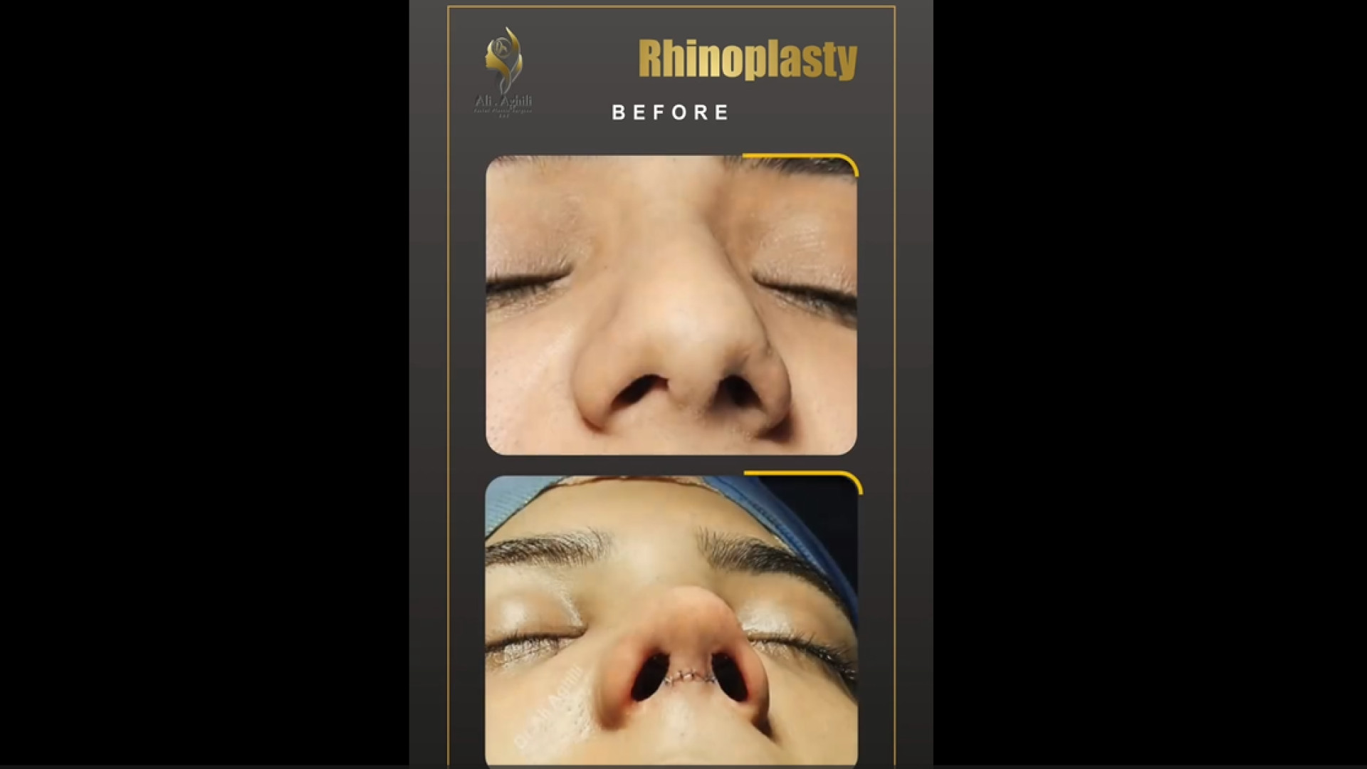 نتیجه جراحی بینی بلافاصله بعد از عمل دکتر علی عقیلی - جراح بینی در تهران