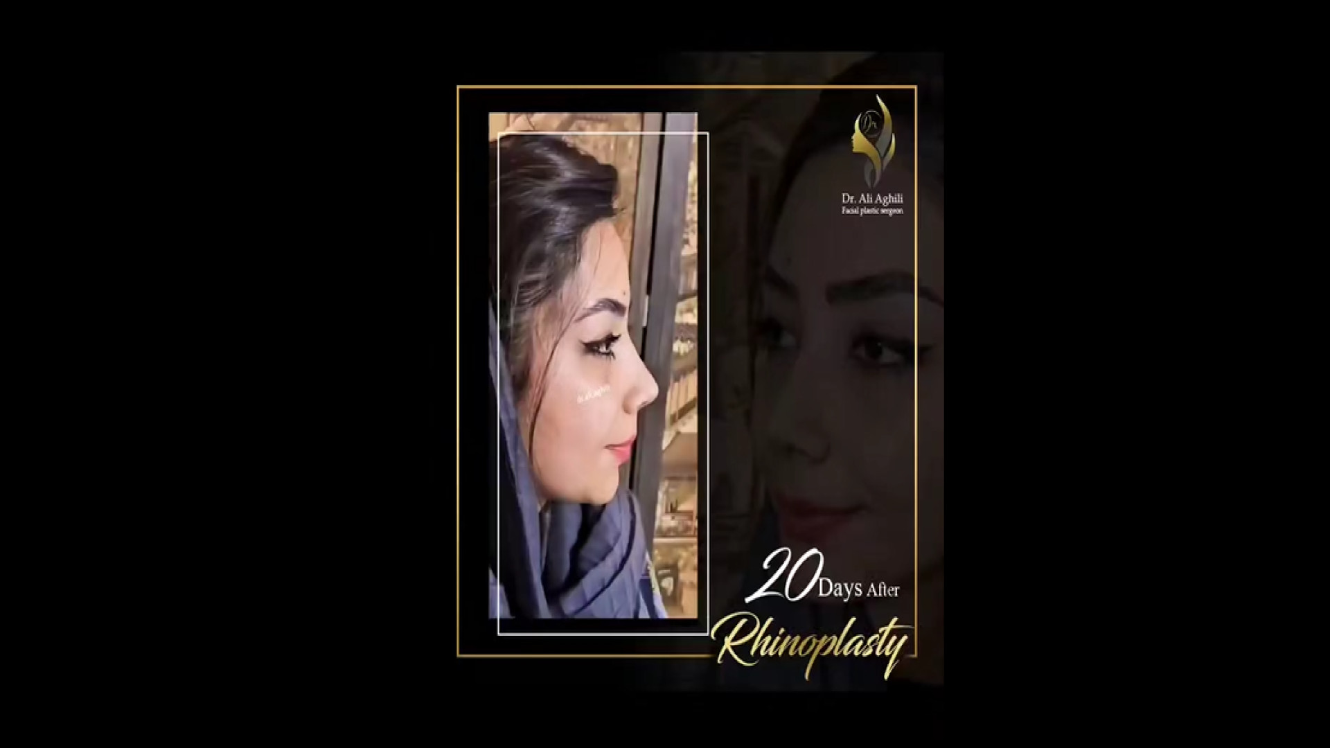 20 روز بعد از جراحی زیبایی بینی دکتر علی عقیلی - جراح بینی در تهران