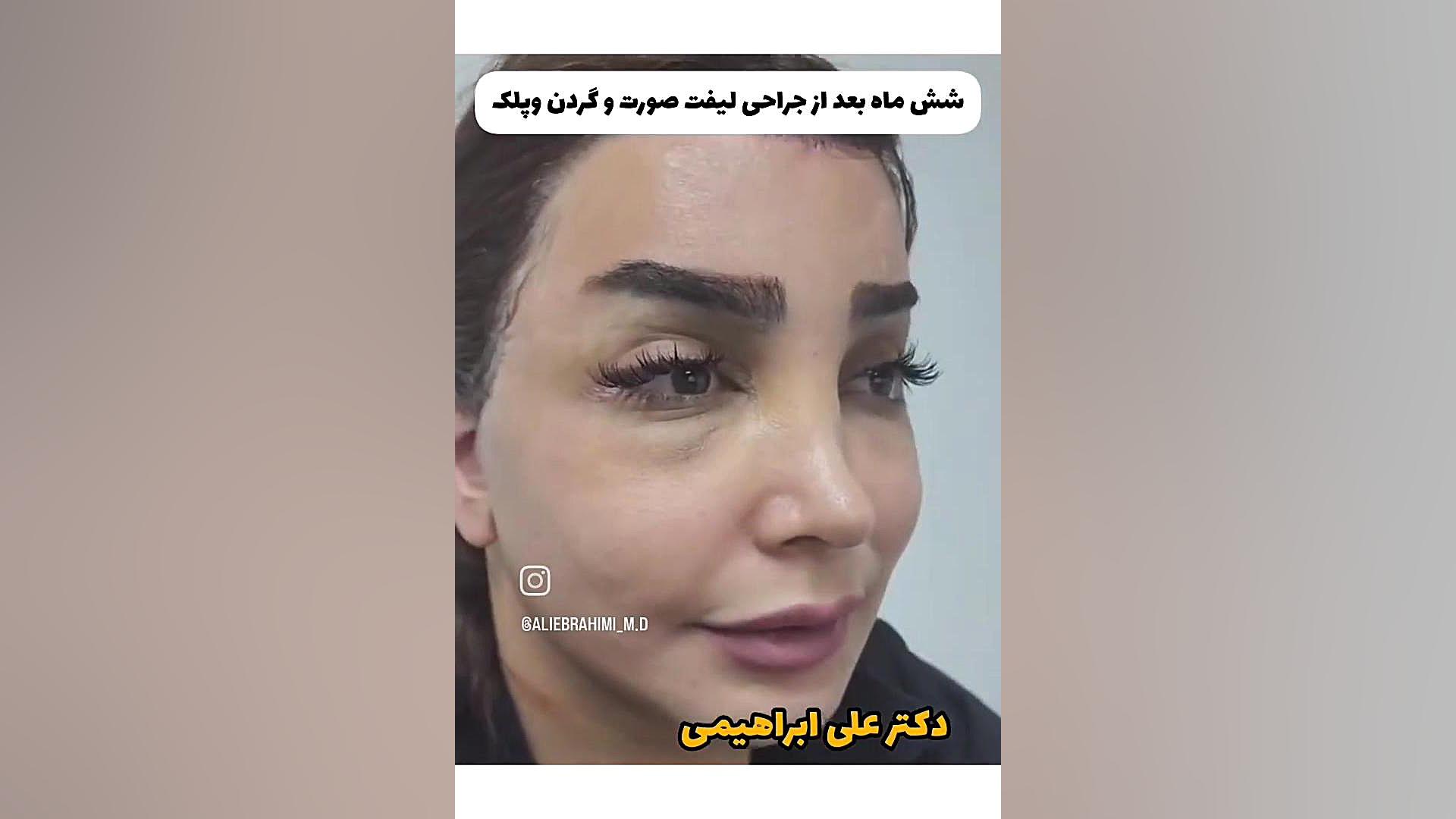 لیفت صورت و گردن بیماری منیر