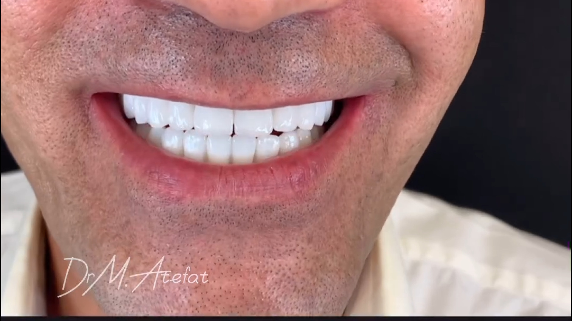 روکش سرامیکی برپایه ایمپلنت در اصفهان | دکتر محمد عاطفت دکتر محمد عاطفت متخصص ترمیمی و زیبایی اصفهان