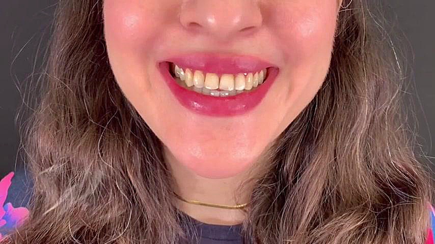 درمان ترکیبی روکش و لمینیت سرامیکی در اصفهان | دکتر محمد عاطفت دکتر محمد عاطفت متخصص ترمیمی و زیبایی اصفهان