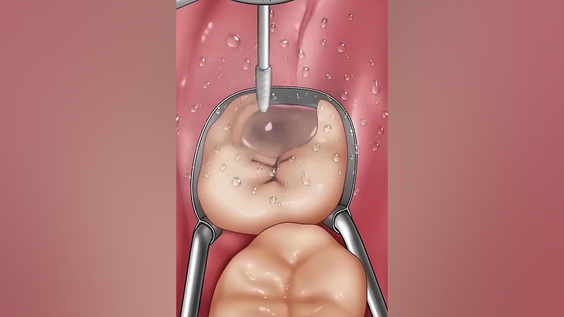 مراحل ترمیم پر کردن دندان ربات میکرونانو جراحی