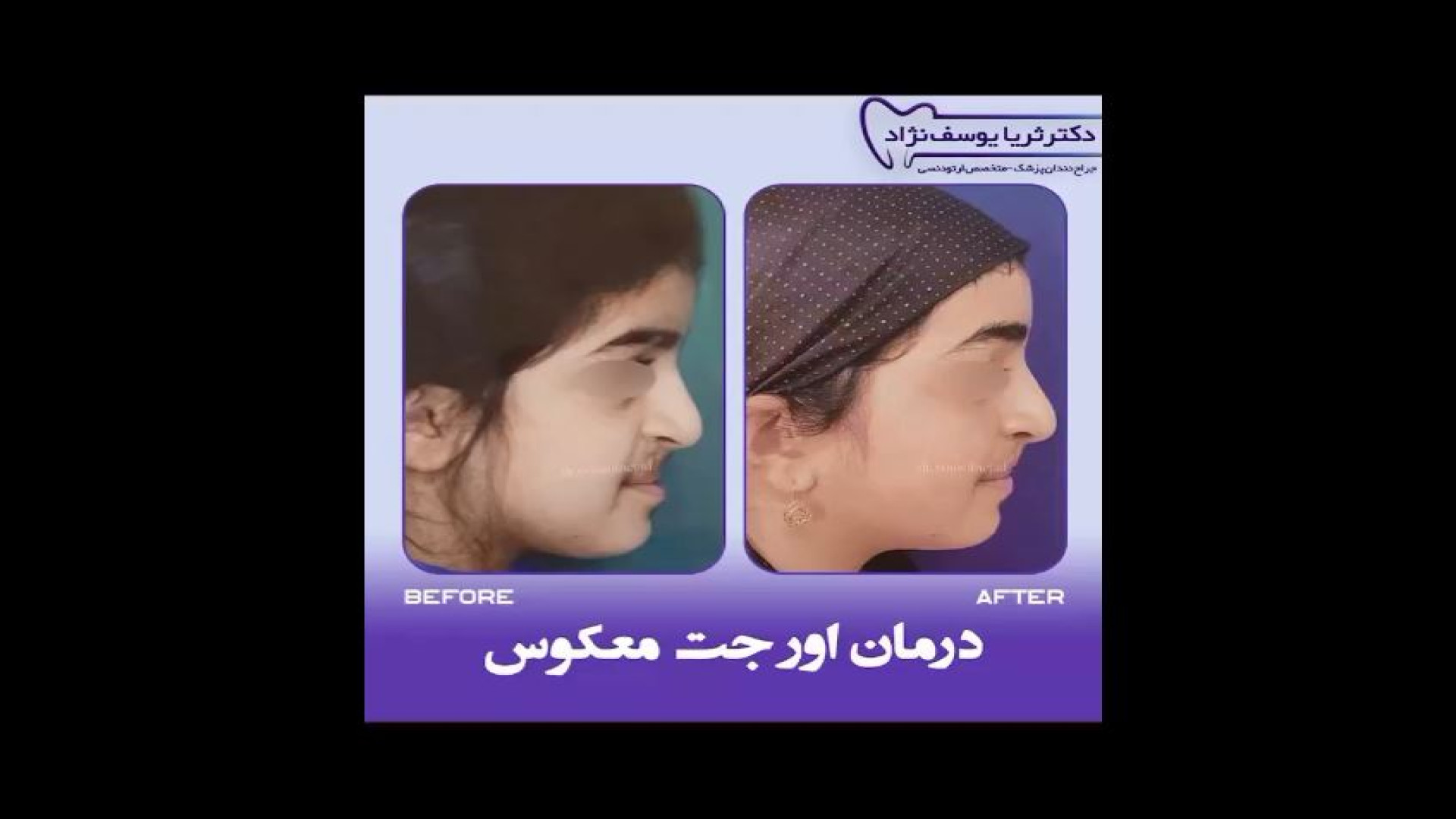 درمان اورجت معکوس | دکتر ثریا یوسف نژاد دکتر ثریا یوسف نژاد متخصص ارتودنسی بابل