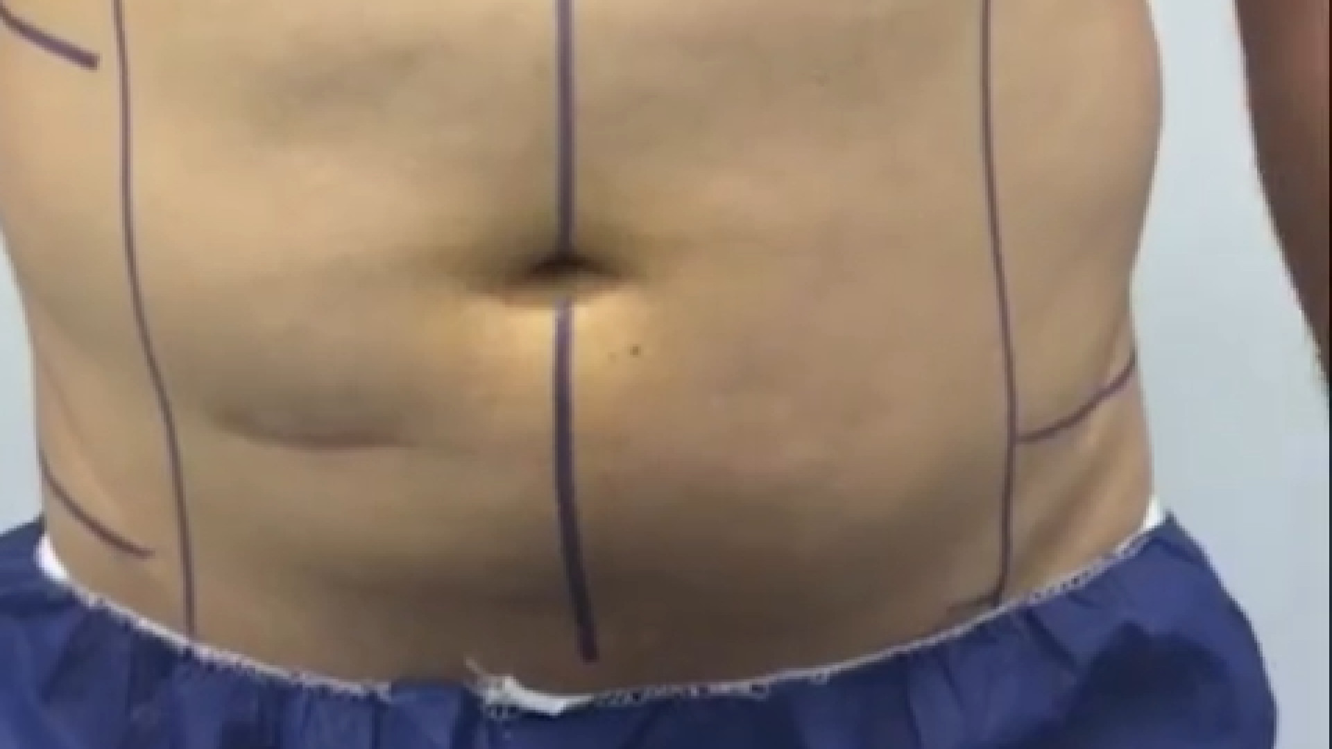 ایجاد سیکس پک با جراحی دکتر بیژن فریدنیا