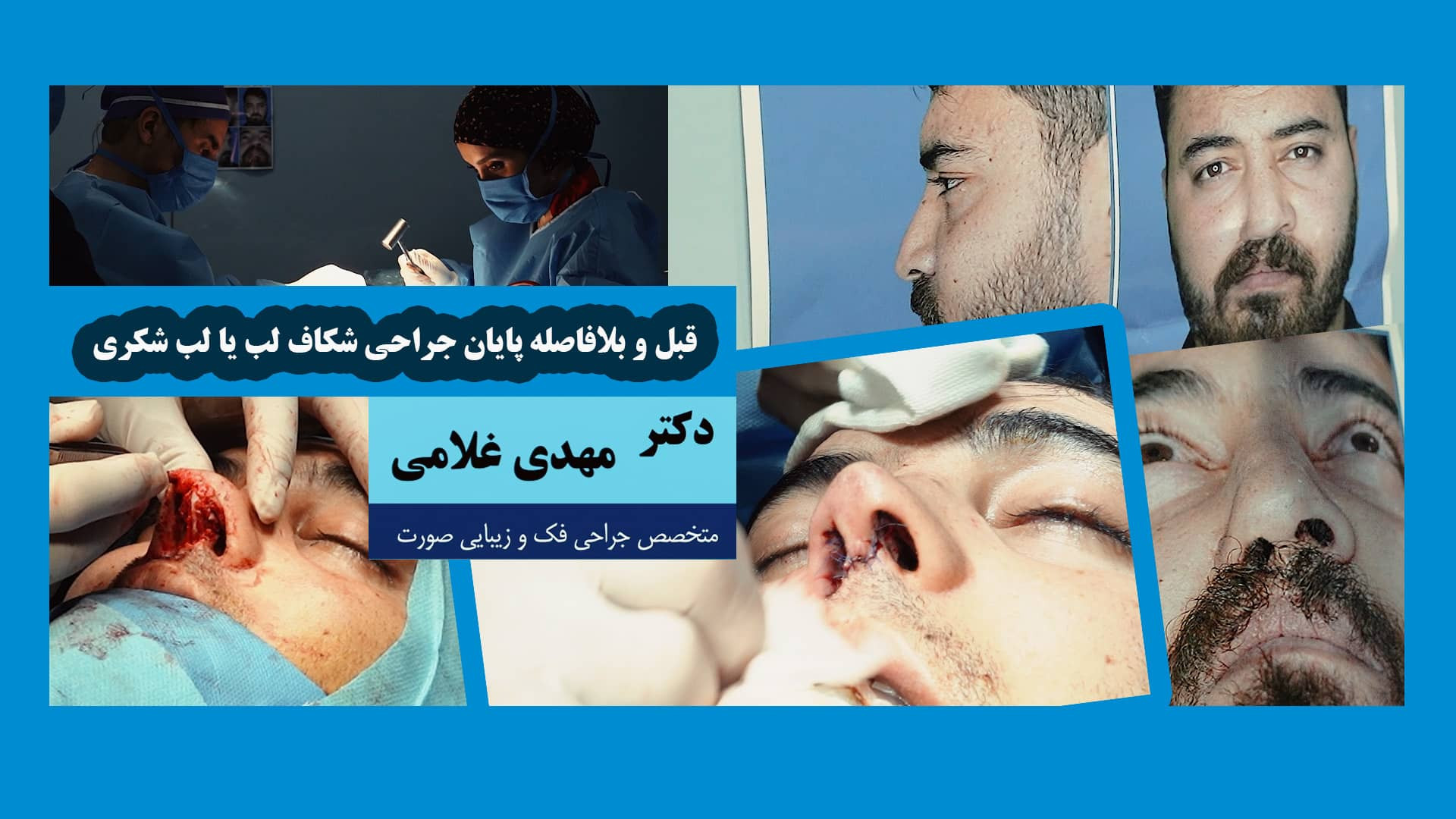 قبل و بلافاصله پایان جراحی شکاف لب یا لب شکری دکتر مهدی غلامی